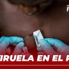 La viruela en el Perú